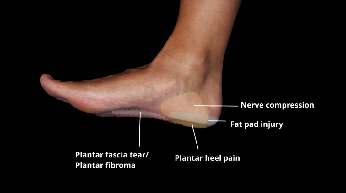 Fat Pad Syndrome - Advance Foot Clinic Podiatry